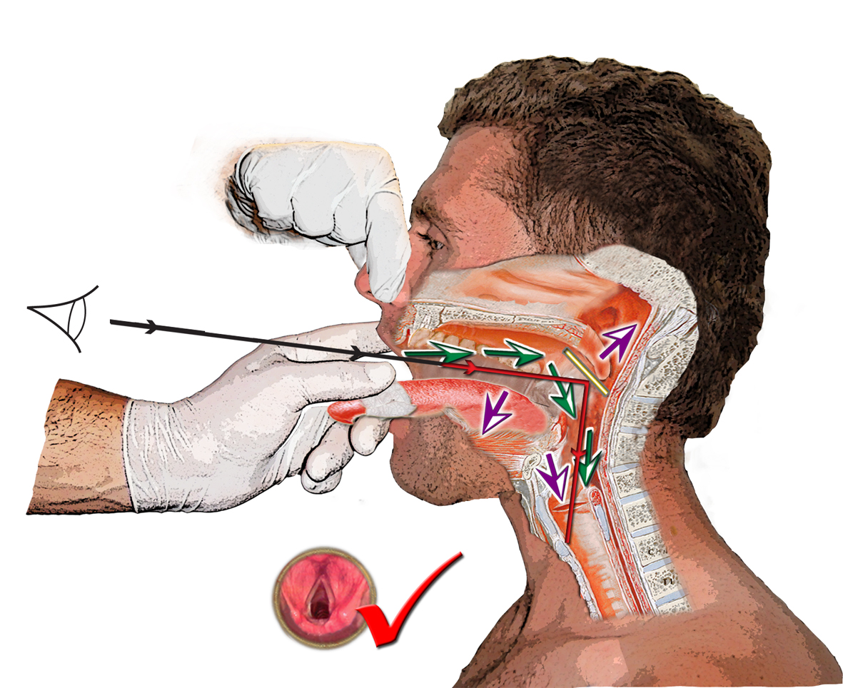 HOW WE DO IT AN IMPROVED TECHNIQUE OF INDIRECT LARYNGOSCOPY